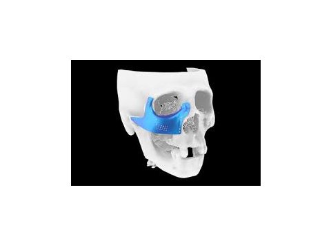 Prótesis craneomaxilofacial (titanio)