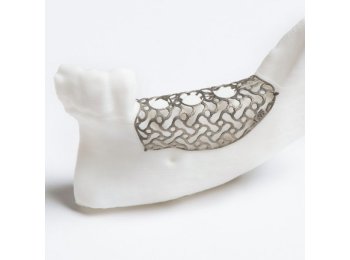 Malla de titanio preformada 100×100 mm