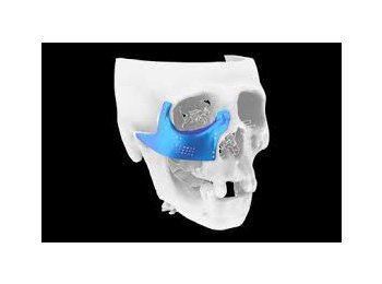 Prótesis craneomaxilofacial (titanio)